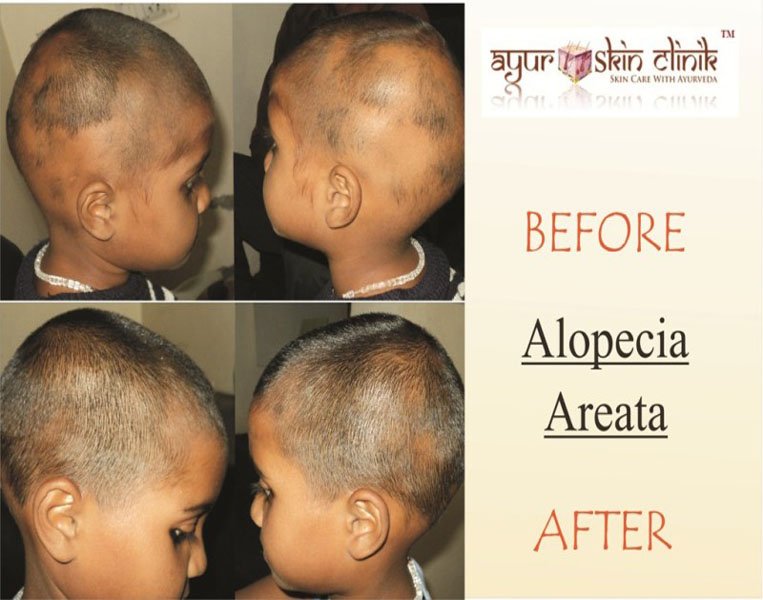 Before and after skin treatment result
